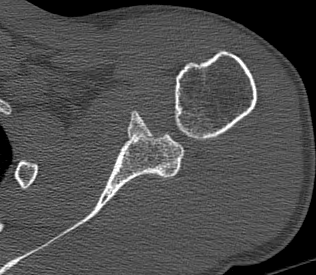 Glenoid Malunion